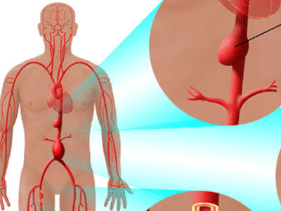Aneurysms in Westchester